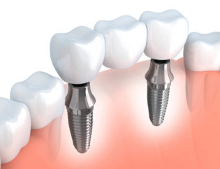 Implantologia torino Dentista impianti